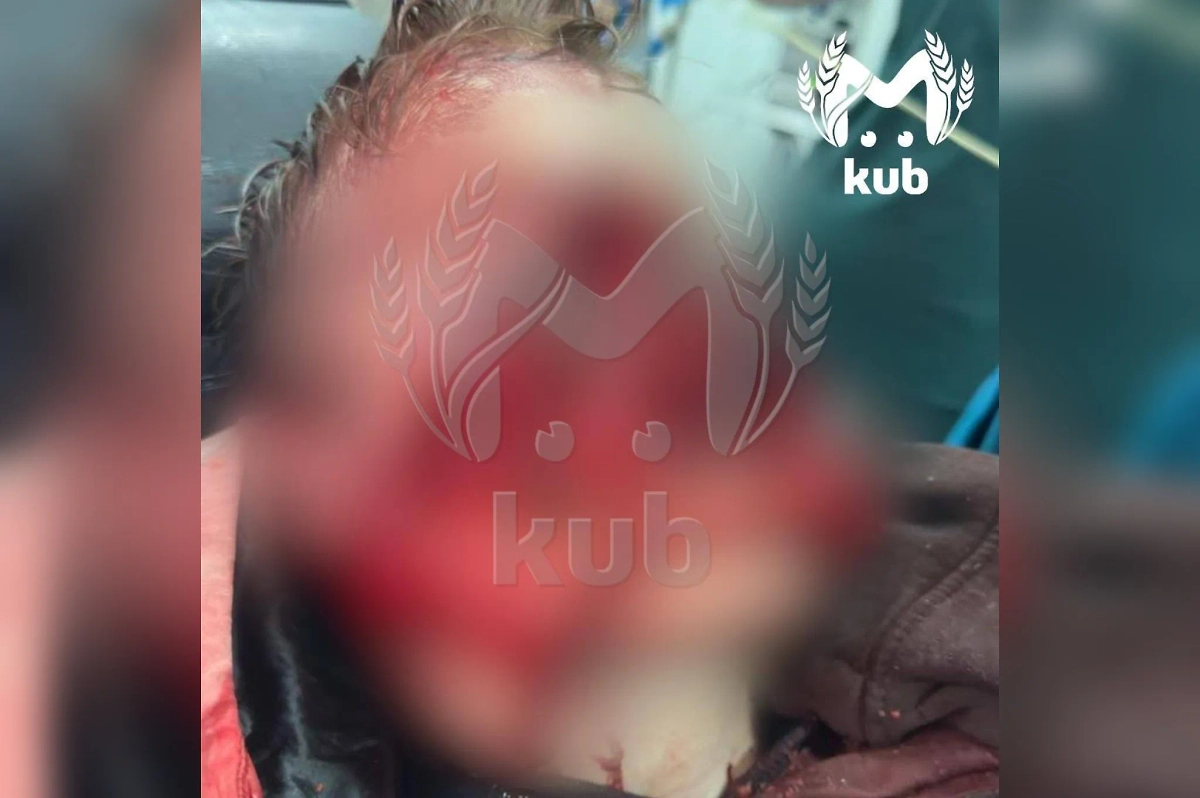 Ребёнок, лицо которого разорвали псы в Адлере. Фото © Kub Mash