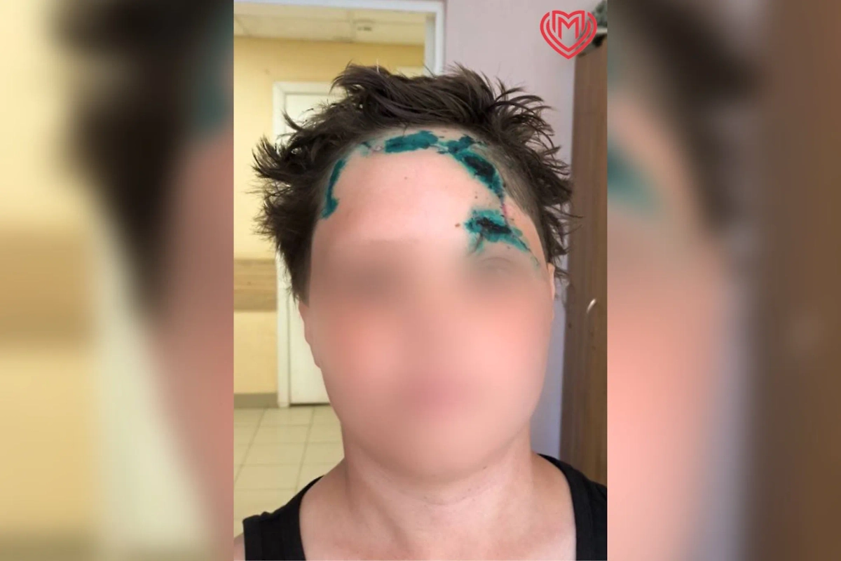 Собака напала на 10-летнего ребёнка и откусила ему лоб. Обложка © Департамент здравоохранения Москвы / Life.ru