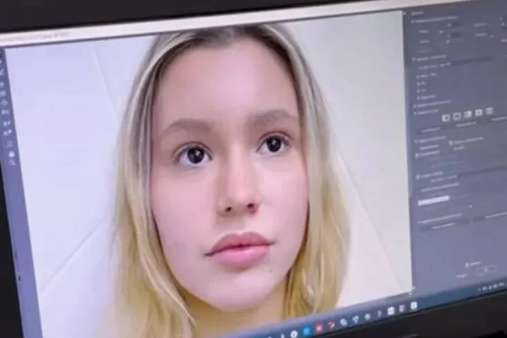 Результат ринопластики Полины Аксёновой. Фото © Instagram (признан экстремистской организацией и запрещён на территории Российской Федерации)/ Danaborisova_official