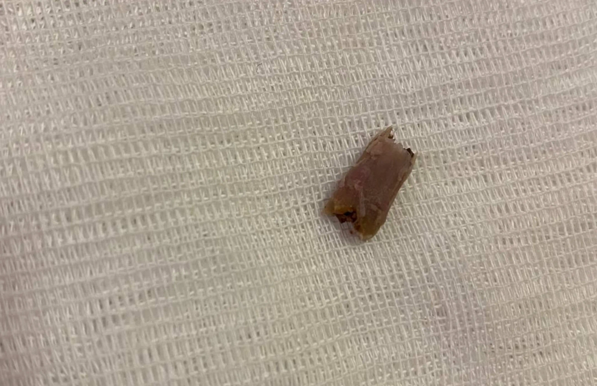 Извлечённая из бронха куриная кость. Фото © Предоставлено Life.ru