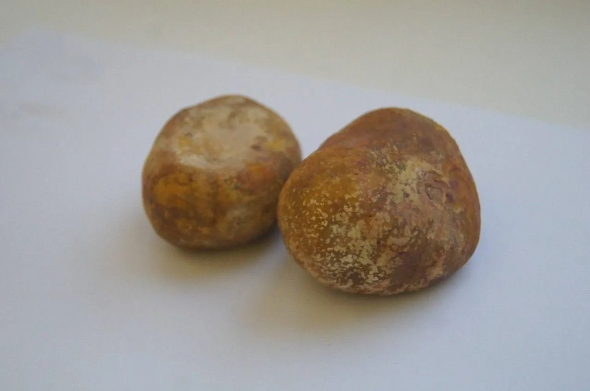 Камни, вытащенные из мочевого пузыря женщины в Подмосковье. Фото © Пресс-служба Минздрава Московской области