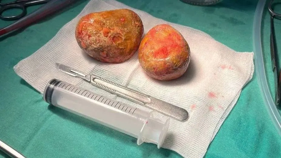 Камни, вытащенные из мочевого пузыря женщины в Подмосковье. Обложка © Пресс-служба Минздрава Московской области