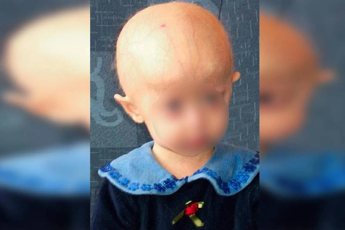 Люди с прогерией слишком быстро стареют и редко доживают даже до 20. Фото © Wikipedia 
