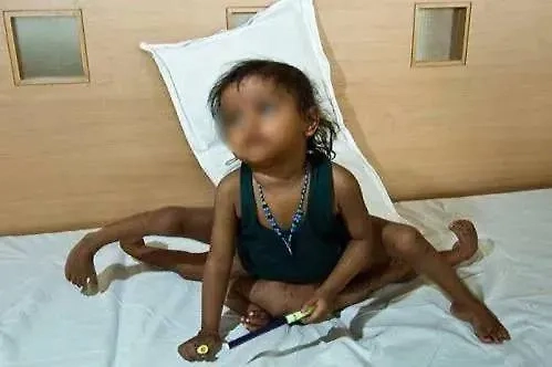 Близнец-паразит — это аномалия развития плода, битва, которая происходит в утробе матери. Фото © Wikipedia / colors.life