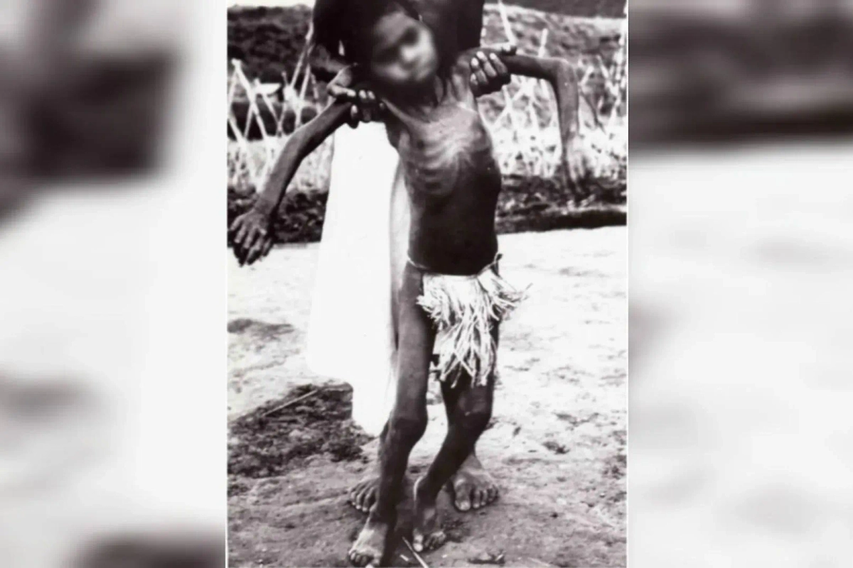 Болезнь куру поражает прежде всего мозг, ныне почти не встречается. Фото © Wikipedia / Liberski PP