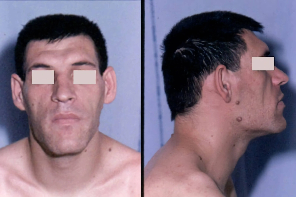 Акромегалия и болезнь Фабри — нарушение производства гормона роста. Фото © Wikipedia / Philippe Chanson and Sylvie Salenave