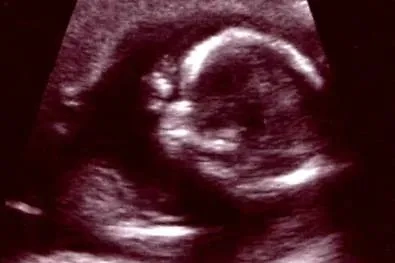 Афалия — это генетическое состояние, которое обусловлено развитием плода в утробе матери. Фото © Wikipedia 