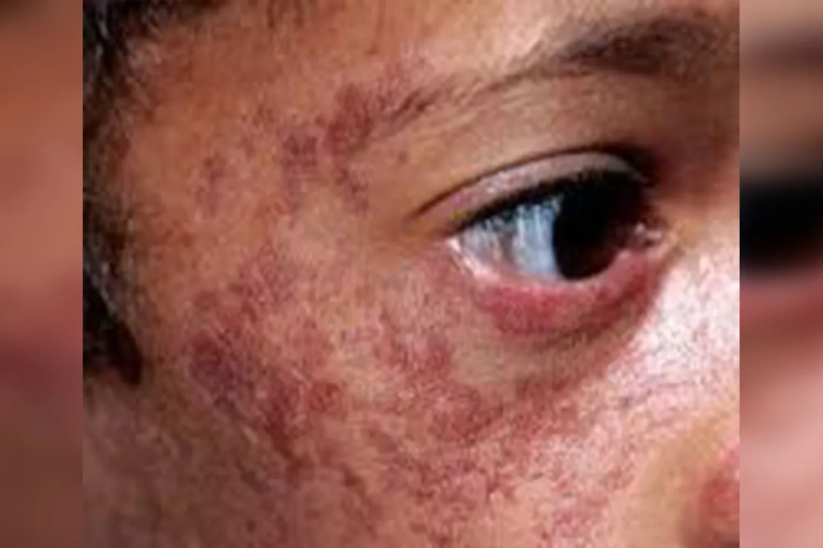 Синдром Блума — это когда есть огромный шанс заболеть многими видами рака. Фото © YouTube / Medical Ignorance 