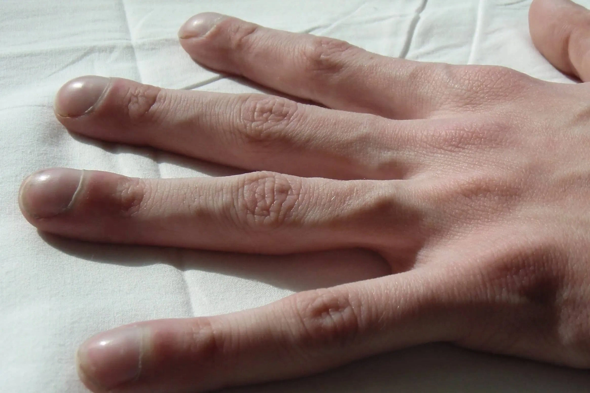 Муковисцидоз — страшная патология, при которой вам пересаживают лёгкие. Фото © Wikipedia / Nick, M.D.