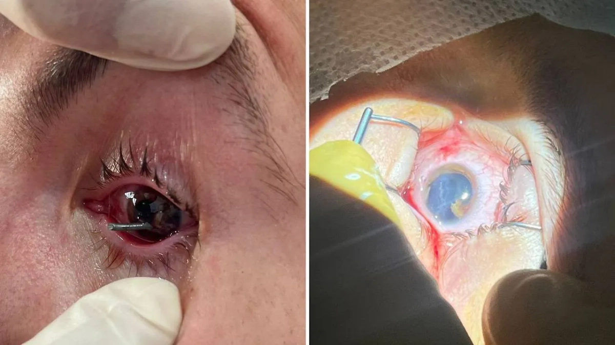 Мужчине попал в глаз гвоздь. Фото © VK/ Айрат Рахматуллин