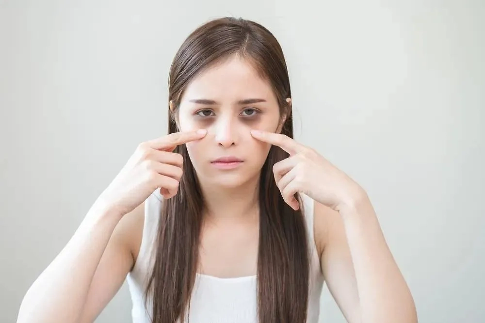 Тёмные круги под глазами как симптом заболеваний или аллергии. Фото © Shutterstock / FOTODOM / Kmpzzz