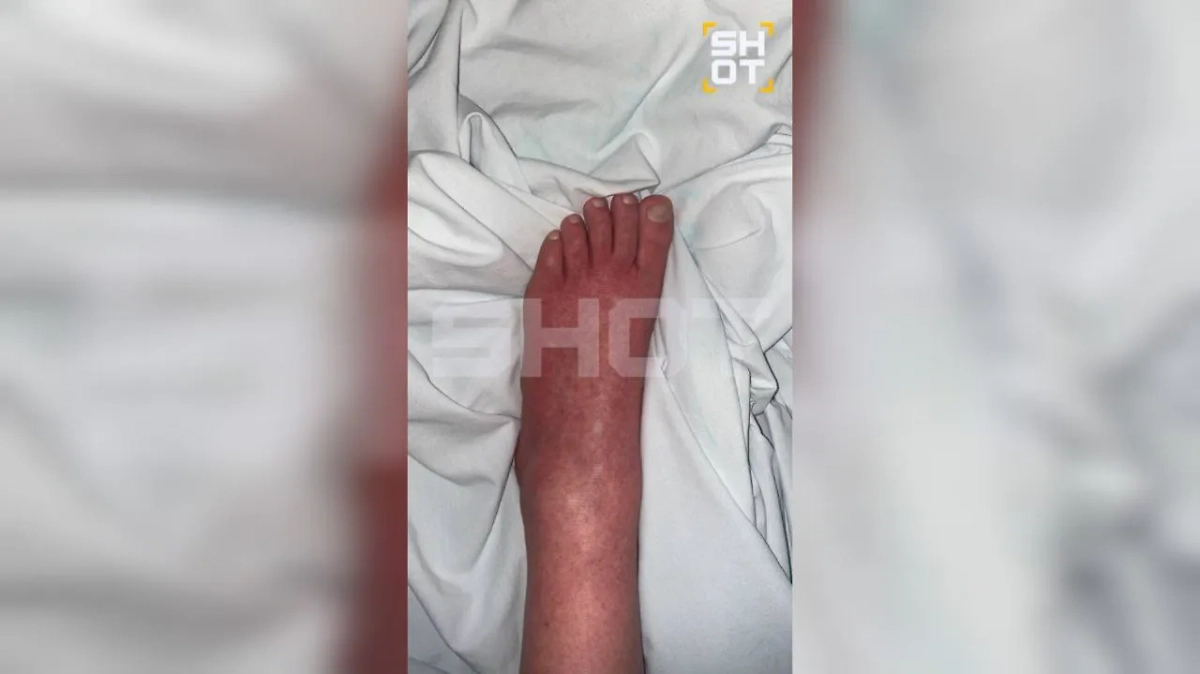 У некоторых пострадавших распухают и отнимаются ноги. Фото © SHOT