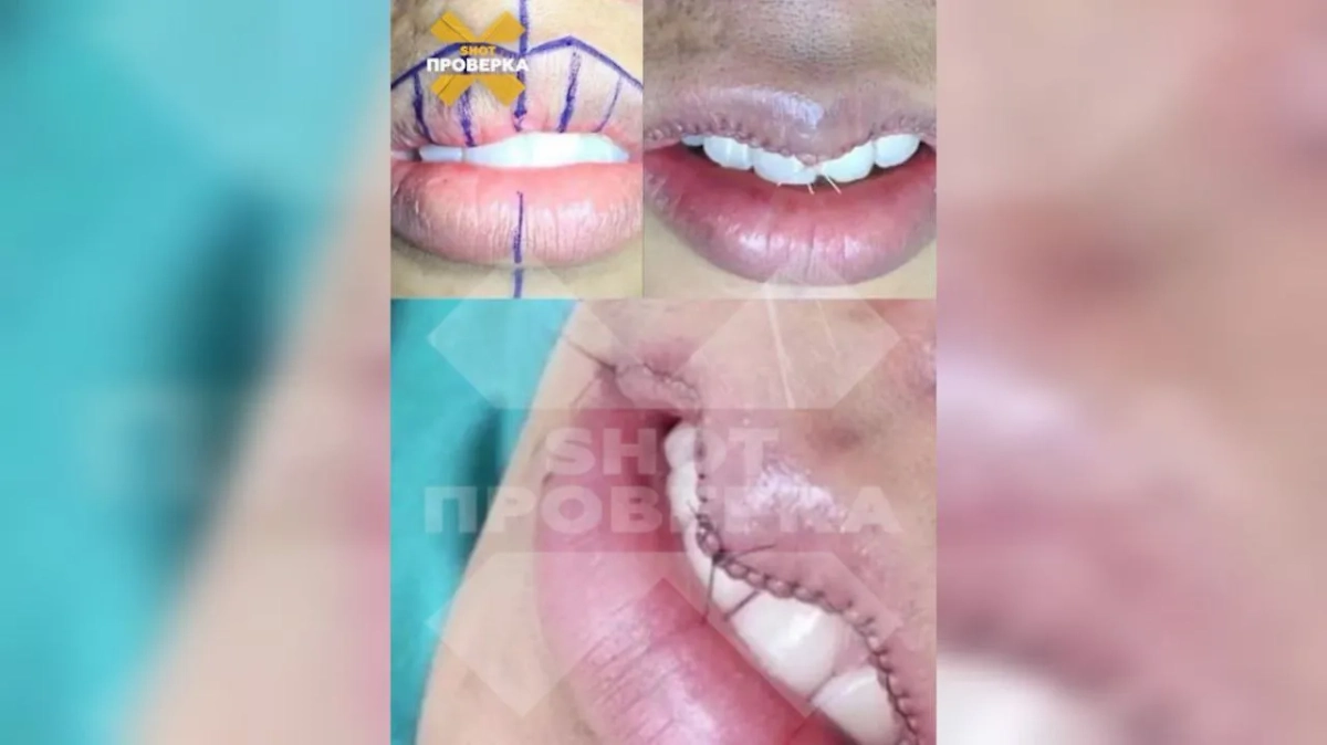 Тренд на губы-ласточки. Фото © Telegram/ SHOT ПРОВЕРКА