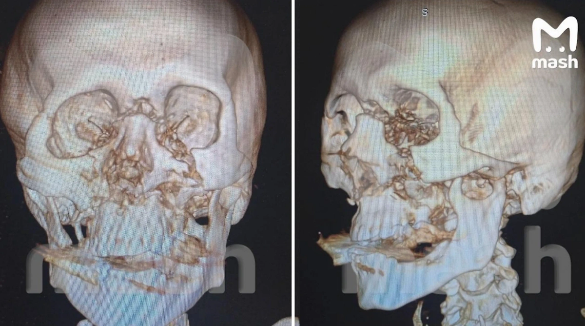 Снимок челюсти пациента. Фото © Telegram / Mash