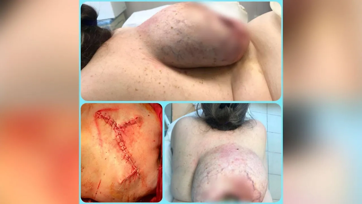 Россиянка десять лет носила на спине 6-килограммовую опухоль, пока та не начала гнить. Фото © VK / Миасская Городская больница №2