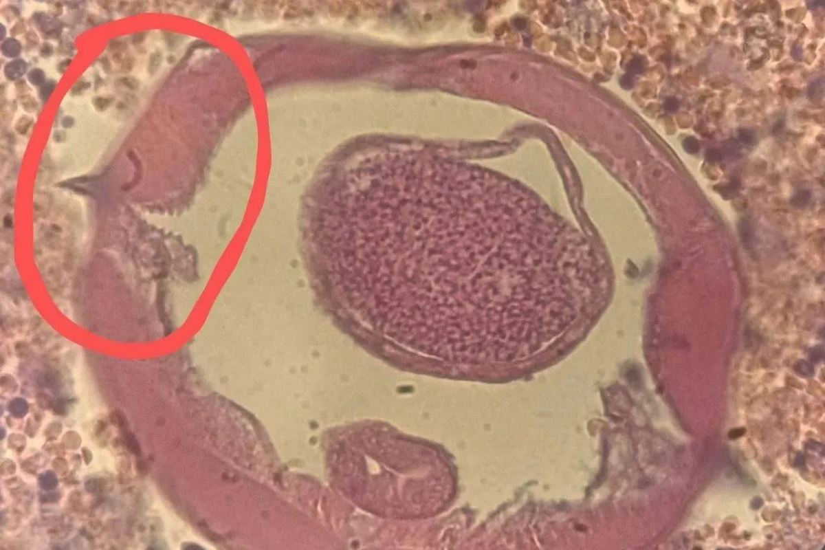 Анкилостома в организме пятилетнего россиянина. Фото © Пресс-служба Минздрава Московской области