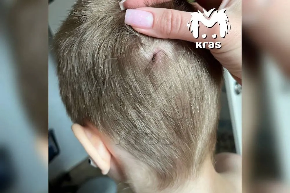 Дети получили травмы. Фото © Telegram / Kras Mash