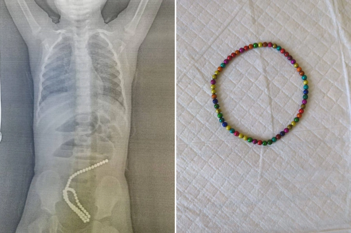 Рентген девочки, из кишечника которой успешно извлекли 60 магнитов. Обложка © Telegram / Минздрав Хабаровского края