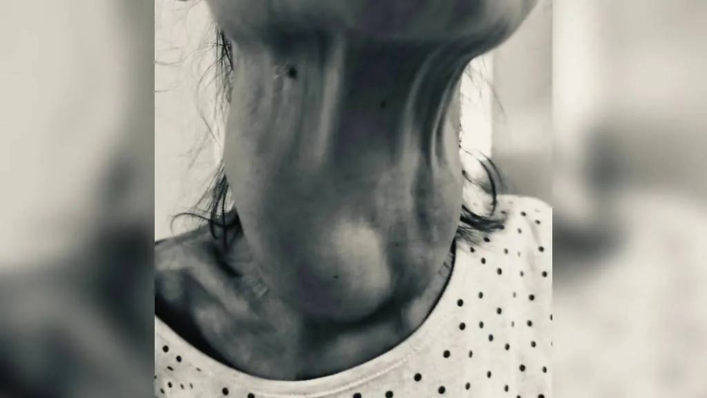 Удалённые мытищинскими хирургами опухоли в шее пенсионерки. Фото © Предоставлено Life.ru