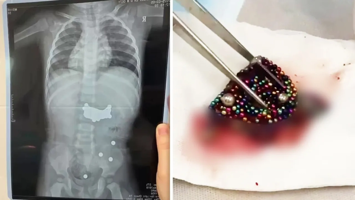 Младенец проглотил 390 магнитов. Обложка © Telegram / drkb05