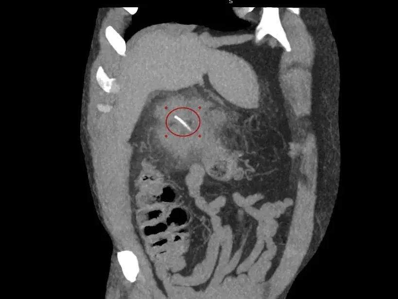 Рыбья кость проткнула кишечник мужчины. Фото © Предоставлено Life.ru