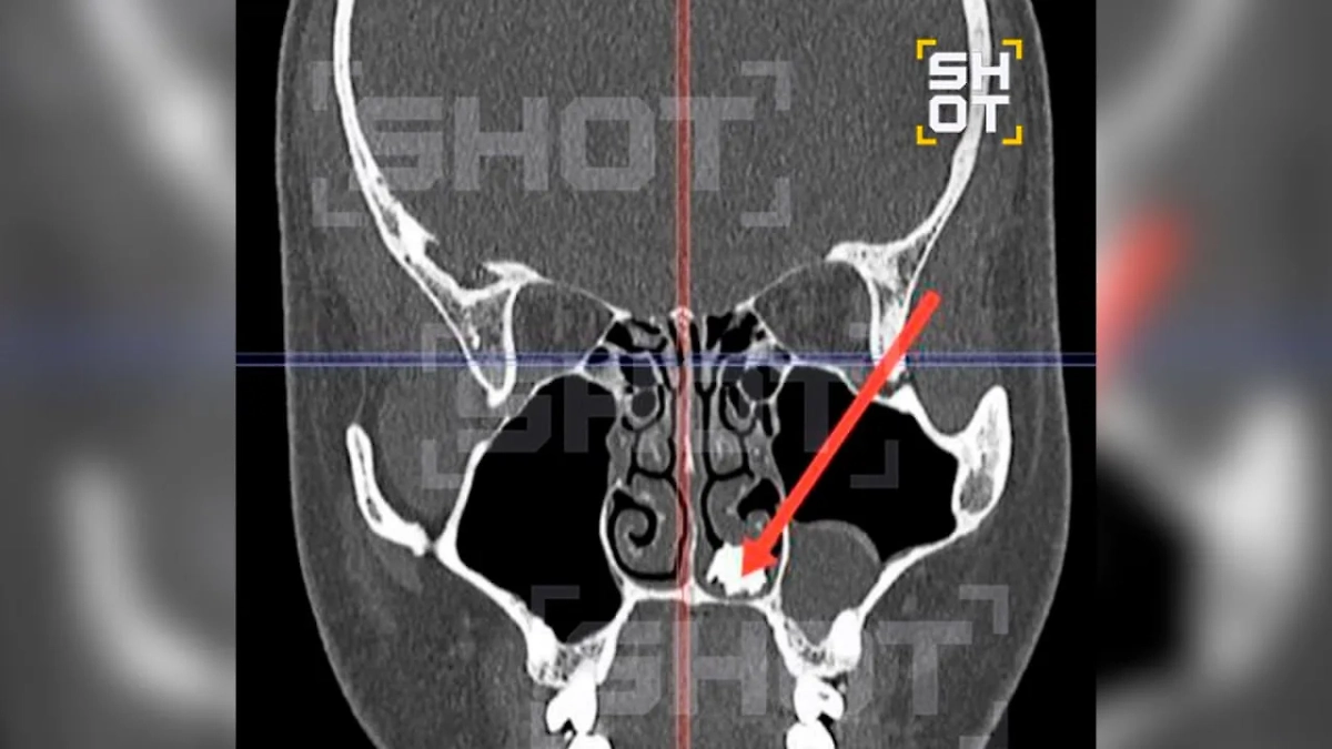 Зуб в носу 22-летнего жителя Подмосковья. Фото © SHOT