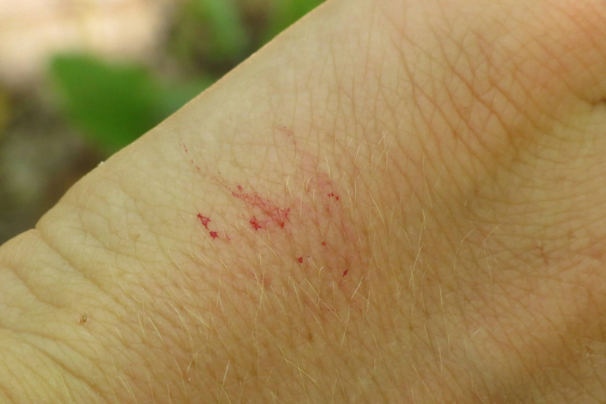 Как выглядит укус змеи. Фото © Wikipedia / Fyn Kynd Photography