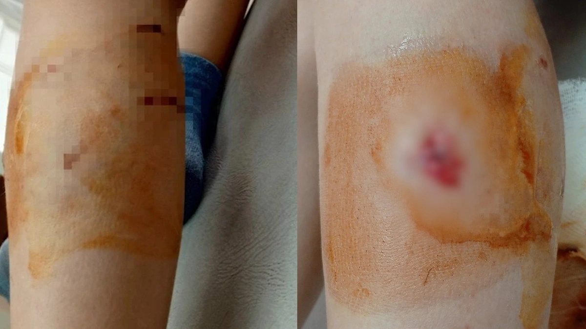 Раны, полученные ребёнком при нападении бродячих собак в Иркутской области. Коллаж © kp.ru