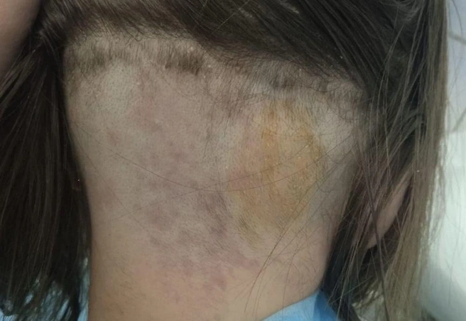 Девочка из-за опасной инфекции начала лысеть после отдыха с родителями в Египте