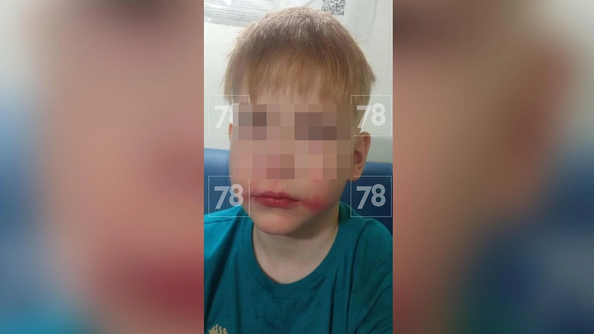 От стресса у Трофима на лице появилась сыпь. Фото © Telegram / 78 | НОВОСТИ