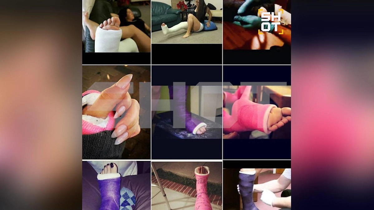 «Травма-фетишисты» охотятся на девушек в гипсе и аппарате Илизарова. Фото © SHOT