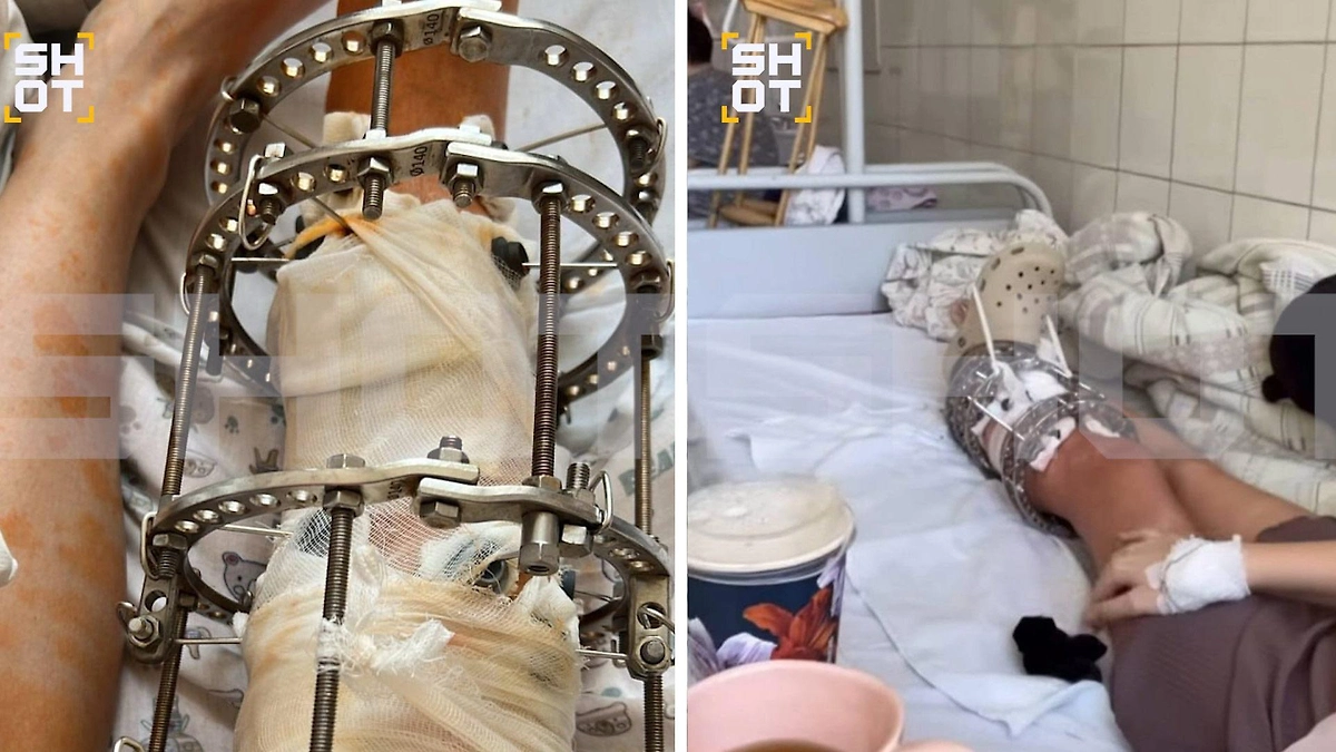 «Травма-фетишисты» охотятся на девушек в гипсе и аппарате Илизарова. Фото © SHOT