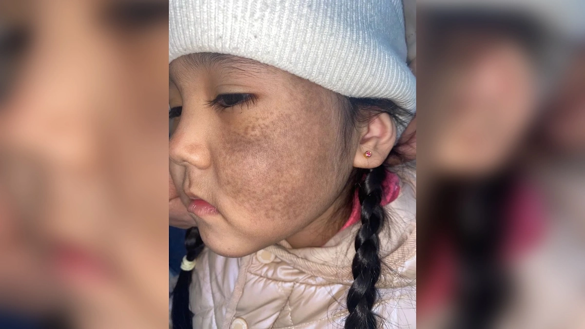 Так выглядело лицо Арины до лечения. Фото © Предоставлено Life.ru