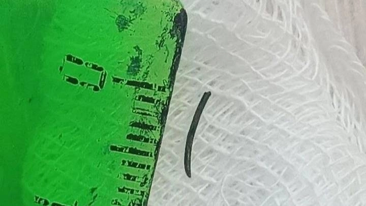 Житель Приморья едва не ослеп из-за отлетевшей щетинки от шлифмашины. Фото ©  ККБ №2