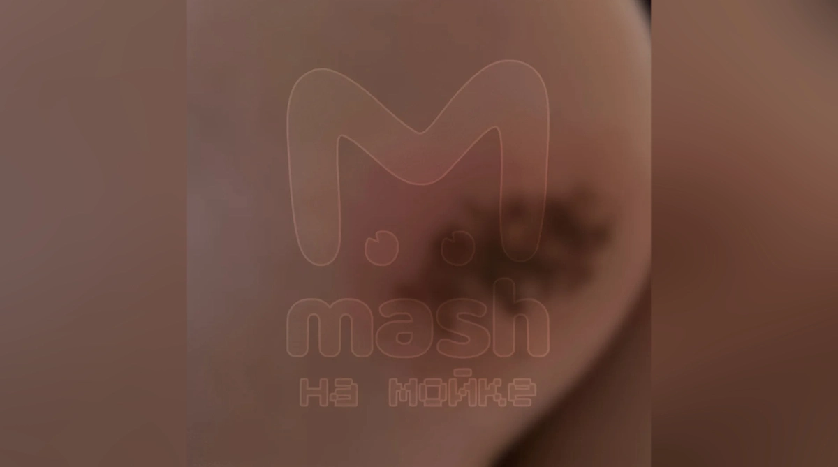 Ожог, который петербурженка получила в автобусе. Фото © «Mash на Мойке»