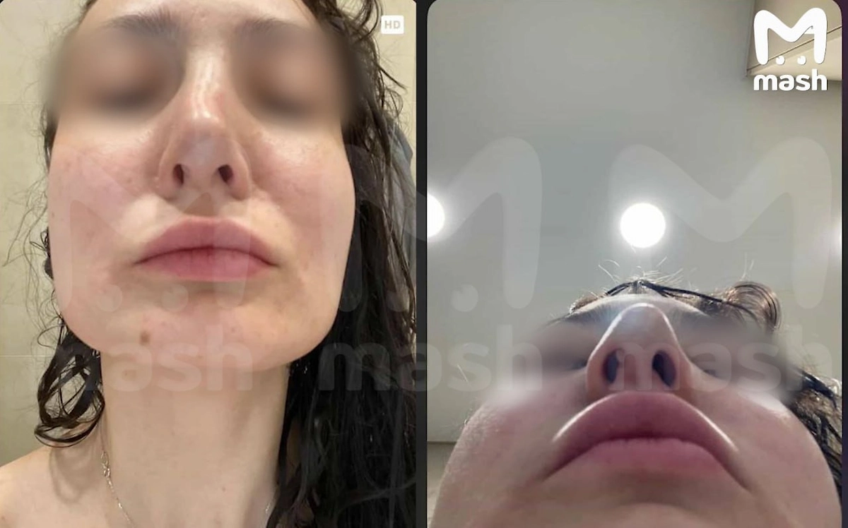 Пациентки обвинили томскую клинику «Генелли» в изуродовании более десяти женщин. Фото © Telegram / Mash