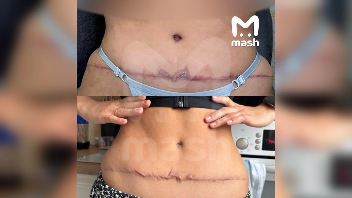 Пациентки обвинили томскую клинику «Генелли» в изуродовании более десяти женщин. Фото © Telegram / Mash