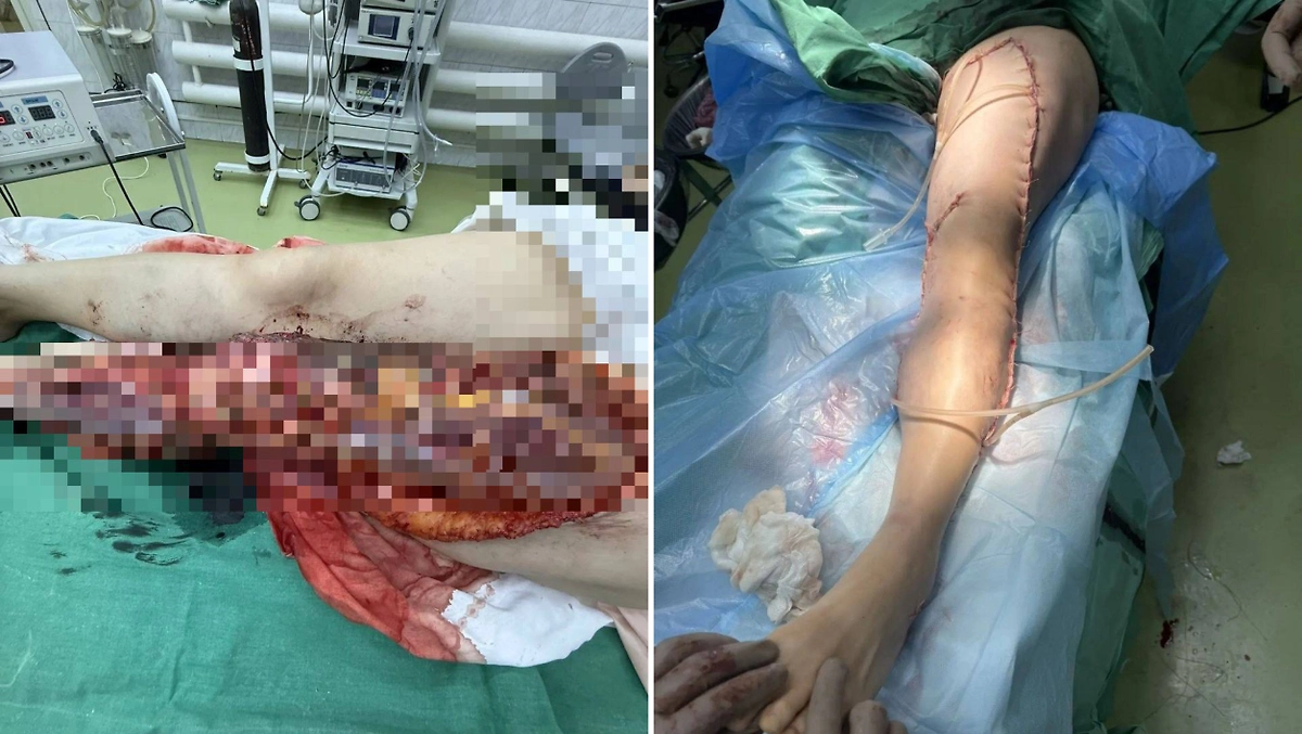 В Подмосковье врачи спасли ногу женщине после тяжёлого ДТП. Фото © Минздрав Московской области