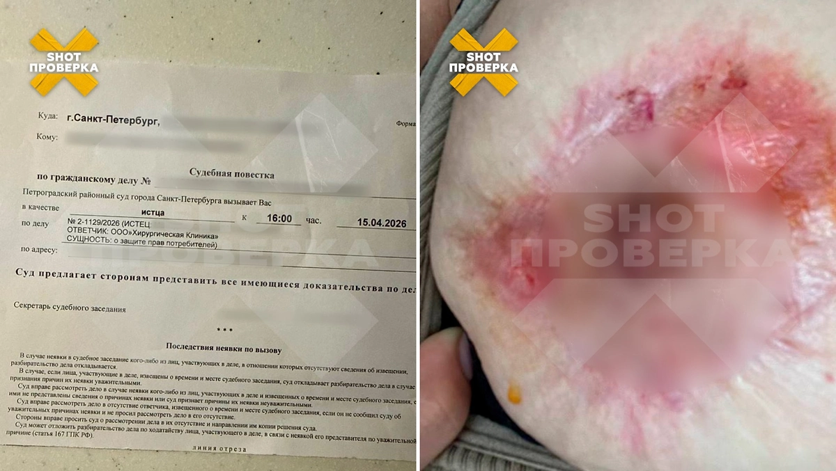 У жительницы Петербурга развился некроз после подтяжки груди. Фото © Telegram / SHOT ПРОВЕРКА