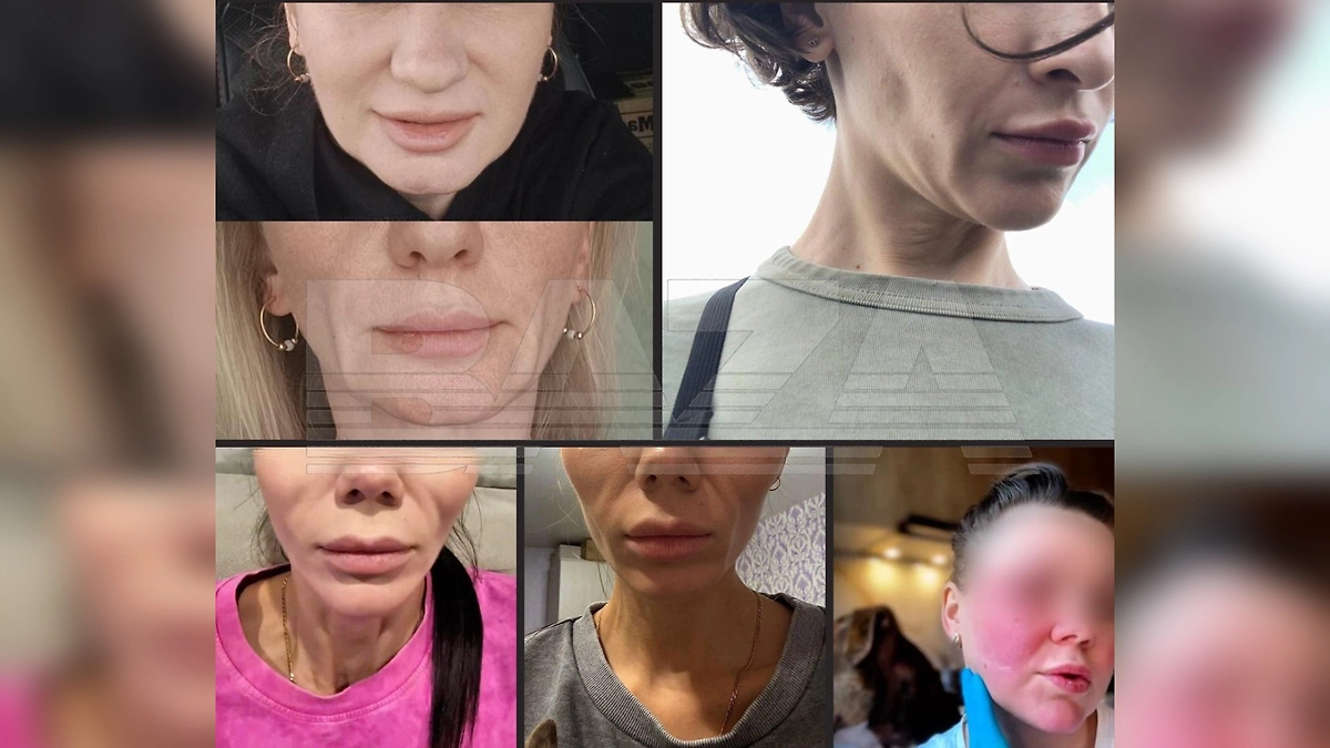 Последствия использования липолитика «Стройность». Фото © Telegram / Baza