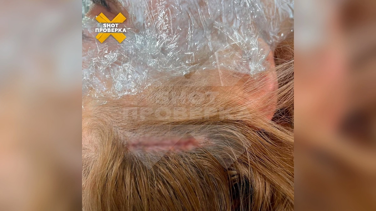 Хирург зашил кожу на голове петербурженки, не вытащив волосы из раны, что привело к нагноению. Фото © Telegram / SHOT ПРОВЕРКА