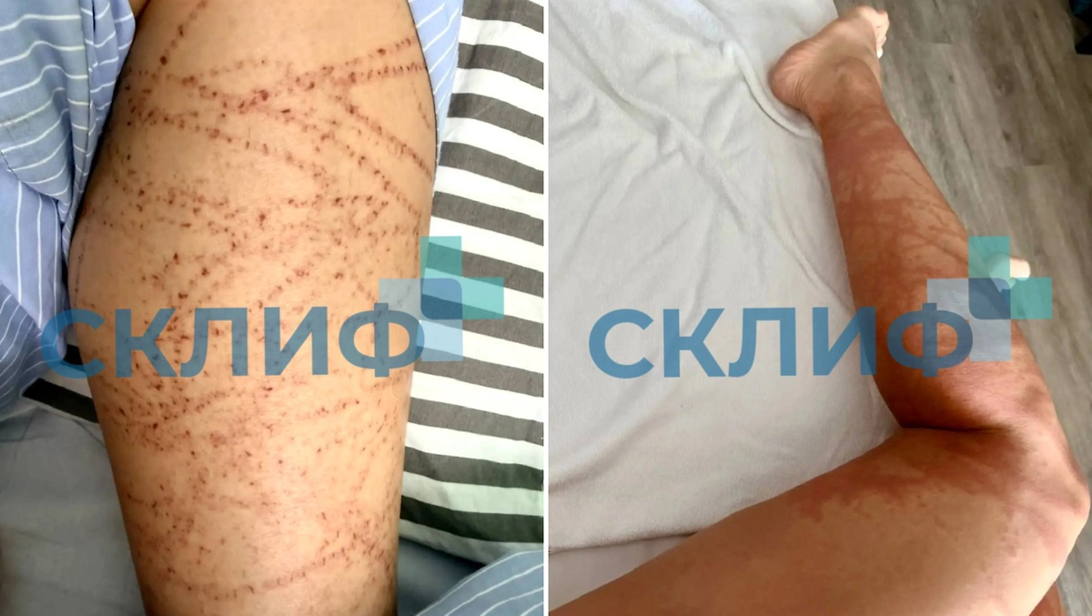 Врачи Склифа вылечили россиянку после ожога кубомедузой в Таиланде. Фото © Telegram / Склиф