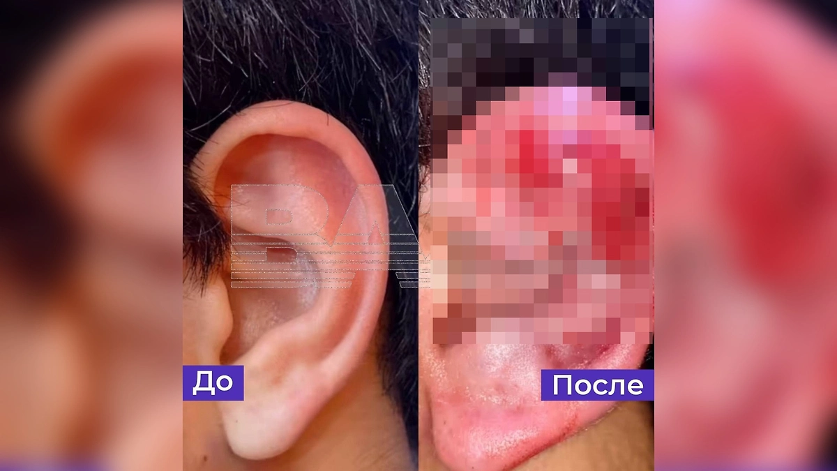 В РФ набирает популярность опасный тренд на «ломку ушей» ради брутального образа. Фото © Telegram / Baza