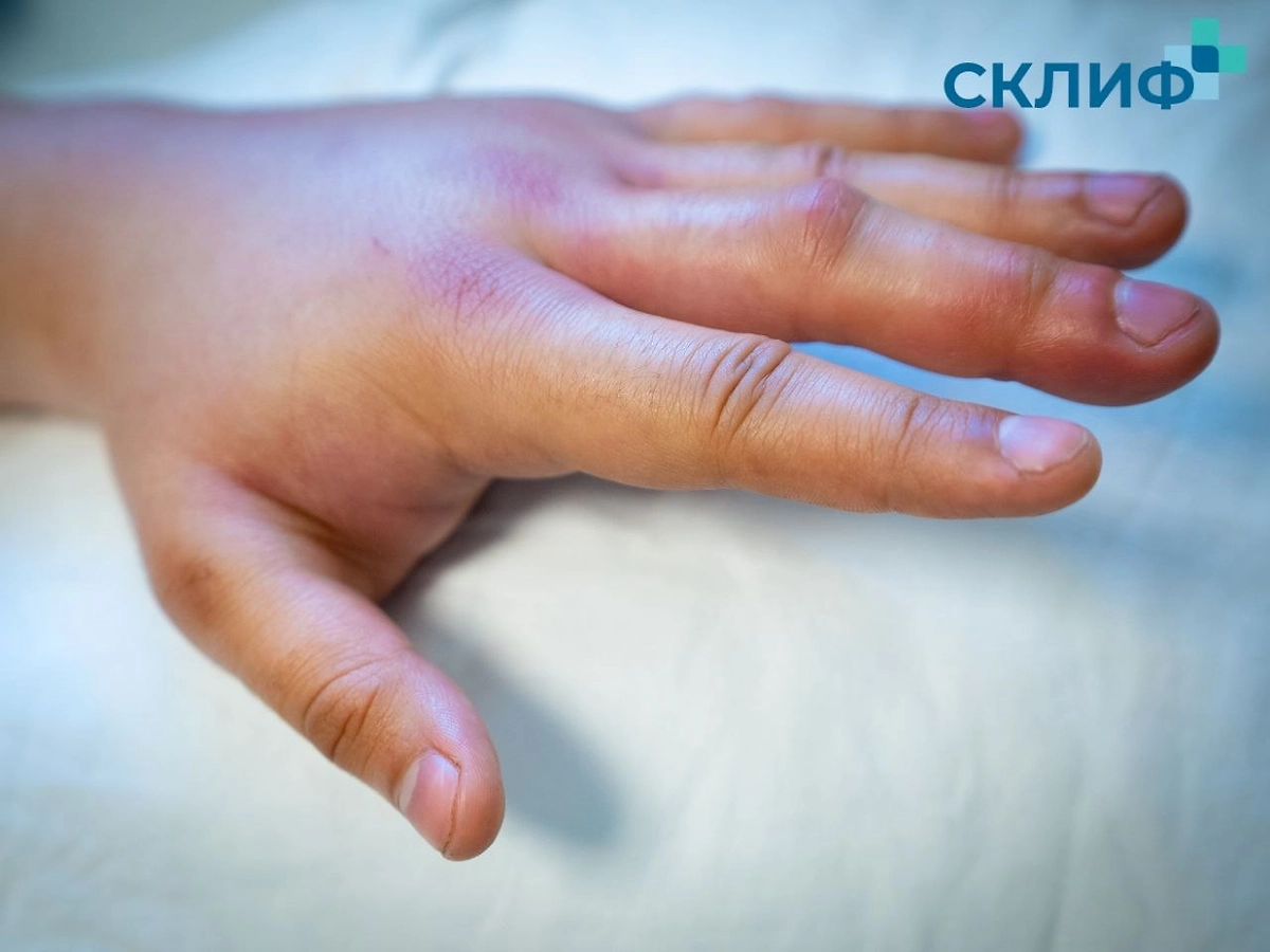 Столичные врачи спасли двух москвичей, один из которых пытался приобрести иммунитет к яду гадюки, а другой верил в целебные свойства борщевика. Фото © Telegram /Склиф