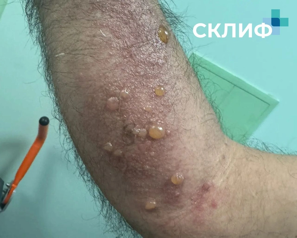 Столичные врачи спасли двух москвичей, один из которых пытался приобрести иммунитет к яду гадюки, а другой верил в целебные свойства борщевика. Фото © Telegram /Склиф