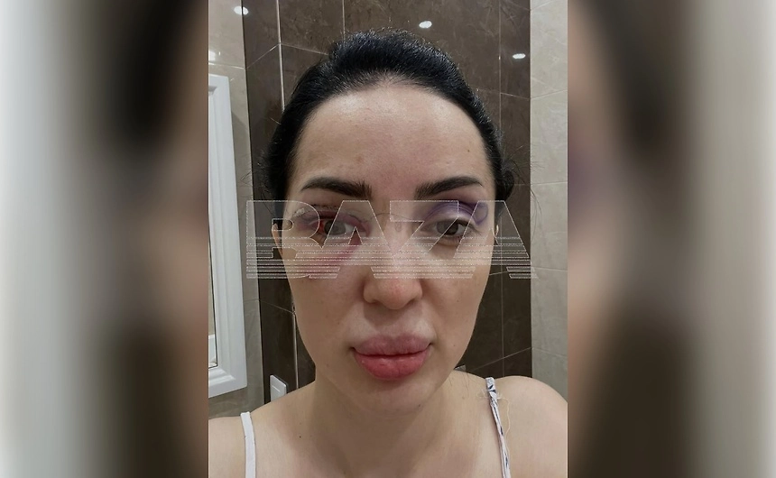 Жительница Махачкалы Валадият после блефаропластики. Фото © Telegram / Baza