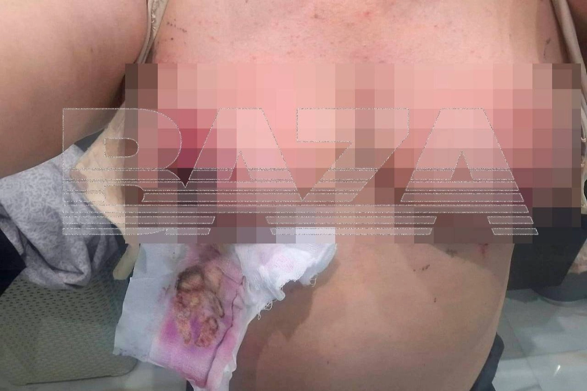 Москвичка попала в реанимацию с некрозом груди после маммопластики/ Фото © Telegram / BAZA