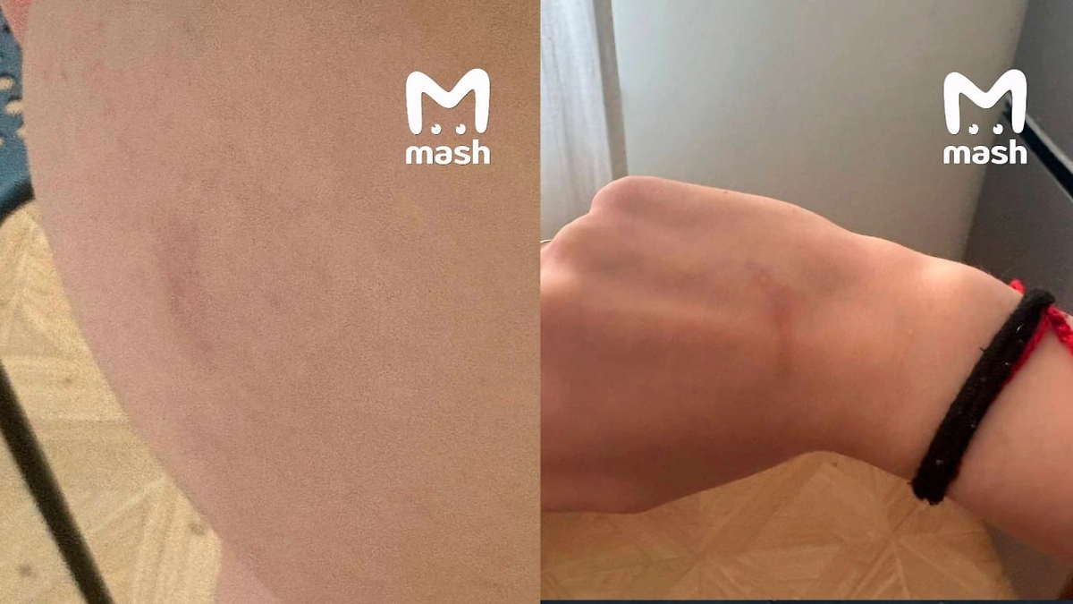Синяки на теле пациентки. Видео © Telegram / Mash
