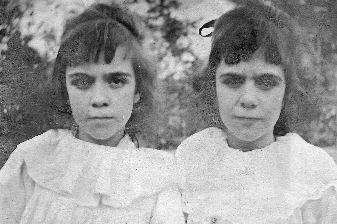 Какие родимые пятна обнаружили у Дженнифер Поллок и почему их посчитали доказательством переселения души Жаклин? Фото © Youtube / БриШоу