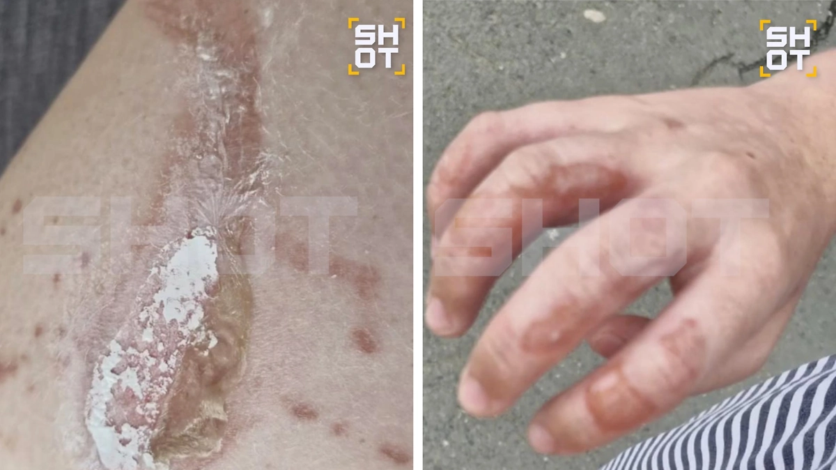 Школьница из России получила ожоги тела от мохито на отдыхе во Вьетнаме. Фото © SHOT